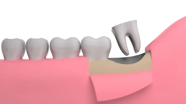 Eliminación Dientes Sabiduría Representación Fondo Blanco —  Fotos de Stock