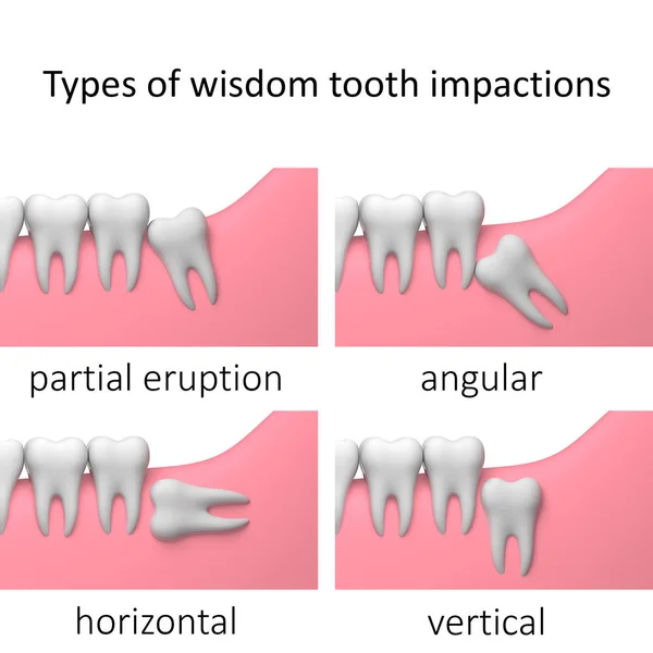 Types of wisdom tooth impactions, white background, collage, 3D-render illustration