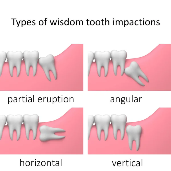 Tipos Impactación Muela Del Juicio Fondo Blanco Collage Ilustración Render —  Fotos de Stock