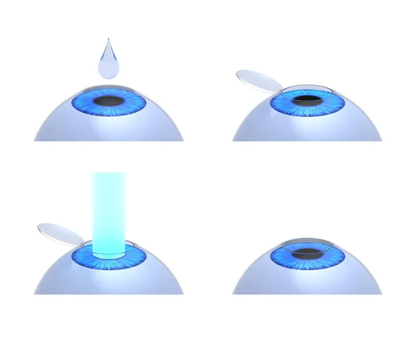 Procedimento Cirurgia Ocular Laser Renderização — Fotografia de Stock