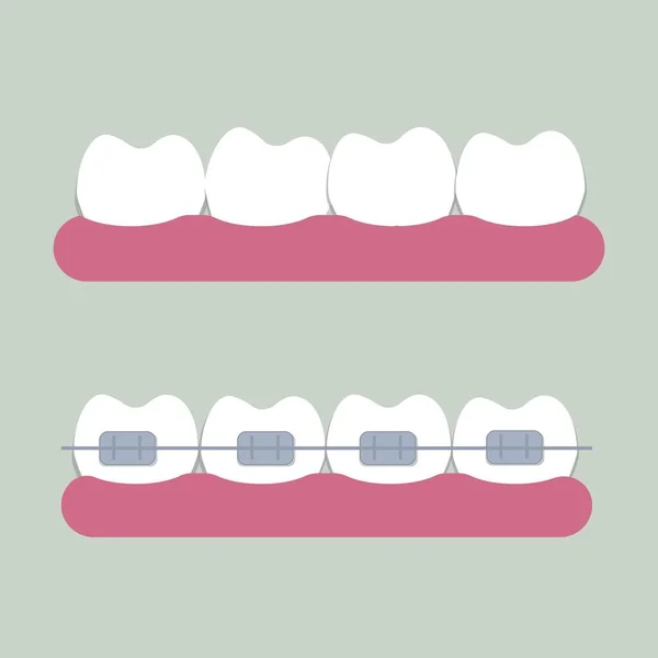 Коррекция зубов ортодонтическими брекетами. Стоматологическая клиника. Векторная иллюстрация в плоском стиле — стоковый вектор
