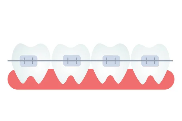 Гумка, зуби з металевими брекетами ізольовані на білому фоні Векторні ілюстрації. Графічна яскрава кліпа, стоматологічна, ортодонтична концепція. Охорона здоров'я та краса ліків . — стоковий вектор