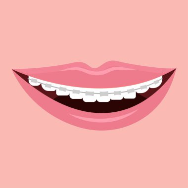 Diş telleriyle gülümse, beyaz arka planda izole edilmiş hisse senedi vektör çizimi yap. Stomatoloji, ortodontik, sağlık konsepti. Düzeltme için diş aletleri. Beyaz dişler, hijyen.