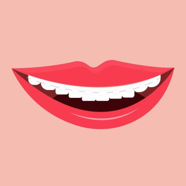 Beyaz Dişleri Seramik Diş telli, gülümseyen, mutlu, moda vektör çizimi. Stomatoloji, ortodontik, diş konsepti. Düzeltici ekipman, sağlık hizmetleri.