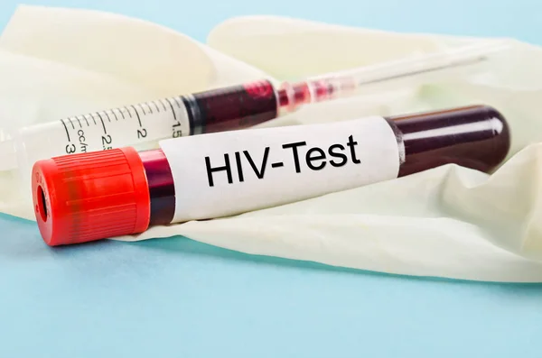 Campione di sangue per il test di screening per il test HIV . — Foto Stock