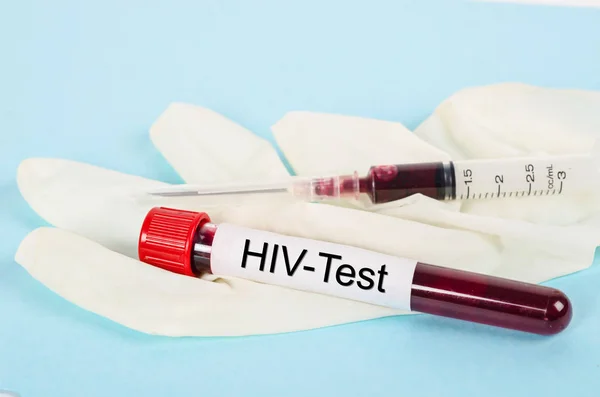 Пробирка для сбора крови с этикеткой для тестирования на ВИЧ . — стоковое фото