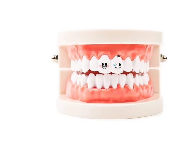 Modèle dentaire, dent tomber malade sur fond blanc — Photo