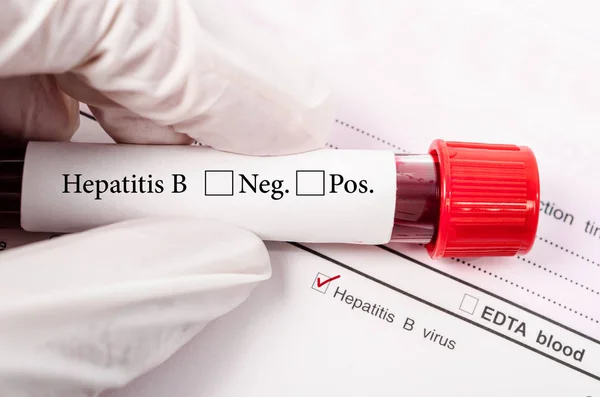 Hepatit testleri için kan tüpü tutan el.