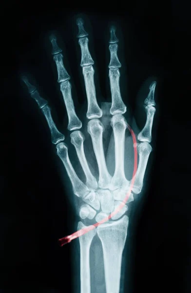 Mänsklig vänster hand på enhet x ray. — Stockfoto