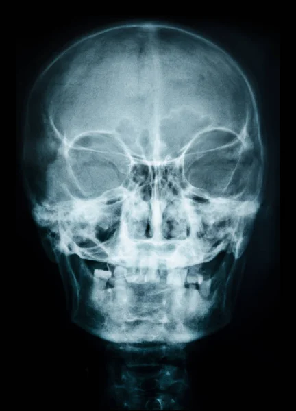 Röntgenbild des Schädels. — Stockfoto