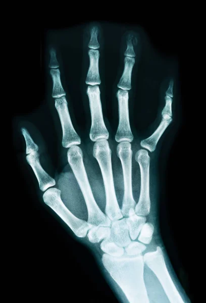 X-ray of a hand — Stock Photo, Image