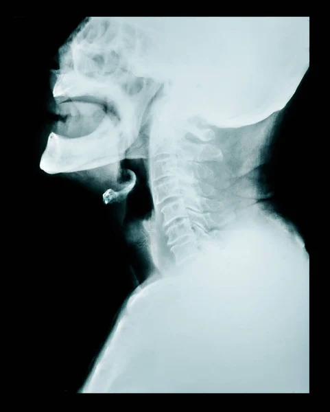 X ray of a neck. — Stock Photo, Image