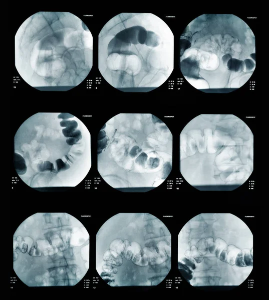 Xray abdomen ntestinal — Stok Foto