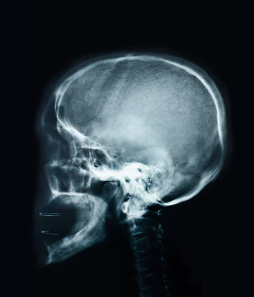 Raio X do crânio humano . — Fotografia de Stock