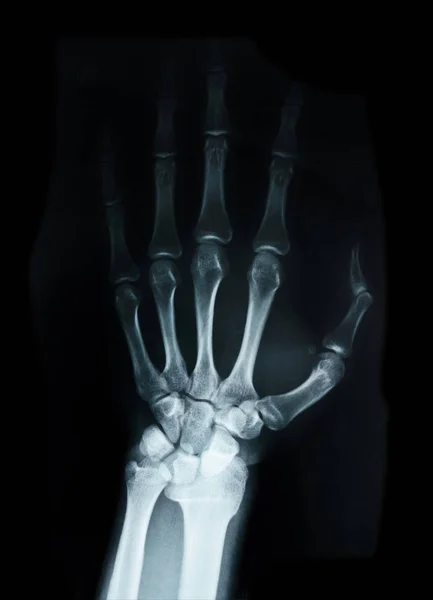 手根骨人間の X 線. — ストック写真