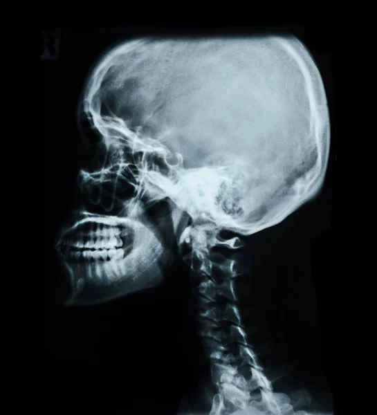Imagem radiológica do crânio humano . — Fotografia de Stock