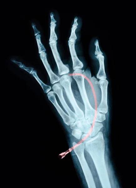 Mänsklig vänster hand på enhet x ray. — Stockfoto