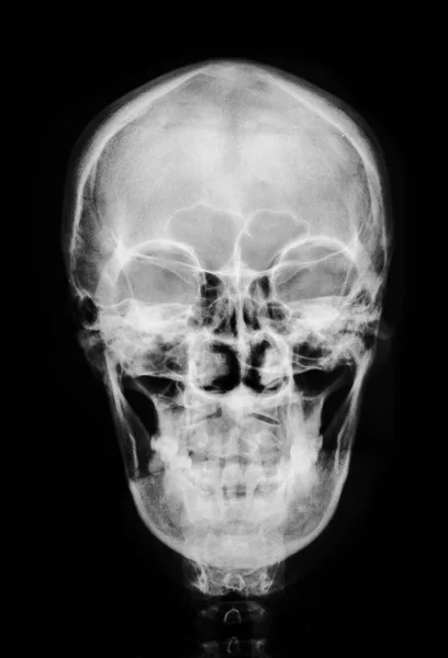 RTG czaszki czołowej. — Zdjęcie stockowe