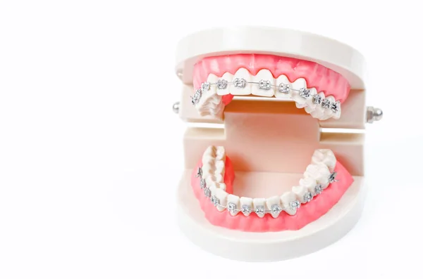 Model Zęba Metalowymi Drucianymi Aparatami Dentystycznymi Izolowanymi Białym Tle — Zdjęcie stockowe