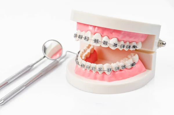Model Zęba Metalowymi Drucianymi Aparatami Dentystycznymi Lustrzanym Sprzętem Stomatologicznym Izolowanym — Zdjęcie stockowe