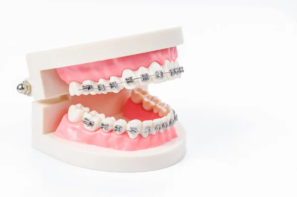 Model Zęba Metalowymi Drucianymi Aparatami Dentystycznymi Izolowanymi Białym Tle — Zdjęcie stockowe