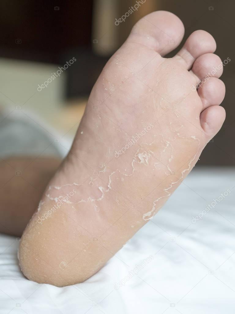 foot fungus