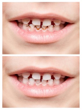 Diş. Çocuk ağız. Fotoğraf portre. Kolaj