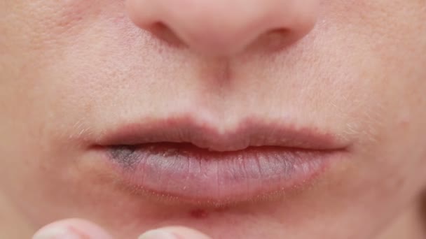 Labios femeninos con moretones. Primer plano. efectos del ácido hialurónico. aumento de labios — Vídeos de Stock