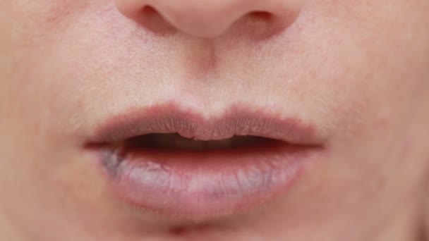 Weibliche Lippen mit Prellungen. Nahaufnahme. Wirkung von Hyaluronsäure. Lippenvergrößerung — Stockvideo