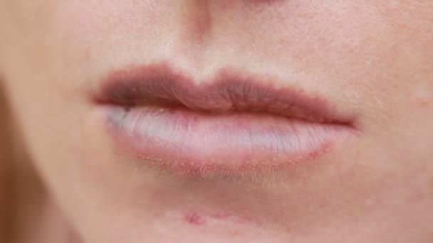Female lips with bruise. close-up. effects of hyaluronic acid. lip augmentation — Stock Video