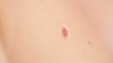 Köstebek insan derisi üzerinde yakın çekim. büyük doğum lekesi