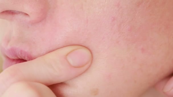 Vrouw verplettert acne op het gezicht. vette huid. probleem huid — Stockvideo