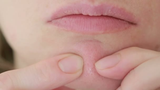Nő szétzúzza akne az arcodra. zsíros bőr. problémás bőr — Stock videók