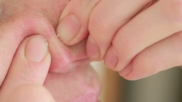 Vrouw verplettert acne op het gezicht. vette huid. probleem huid — Stockvideo