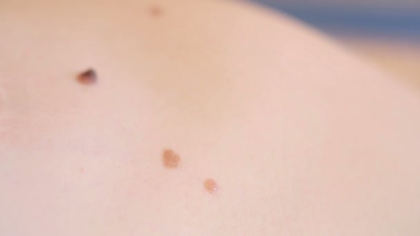 Close up of mole on human skin. large birthmark — ストック動画