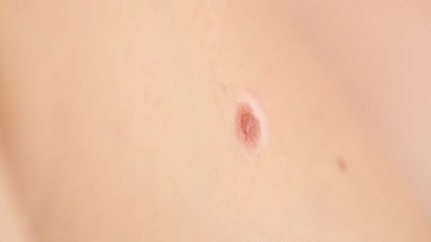 Close up of mole on human skin. large birthmark — Stock video