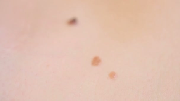 Close up of mole on human skin. large birthmark — ストック動画