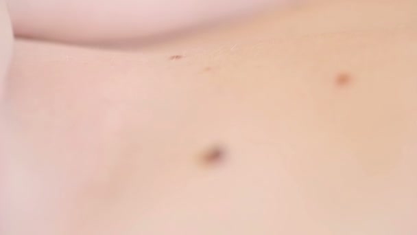 Nahaufnahme von Maulwürfen auf der menschlichen Haut. großes Muttermal — Stockvideo