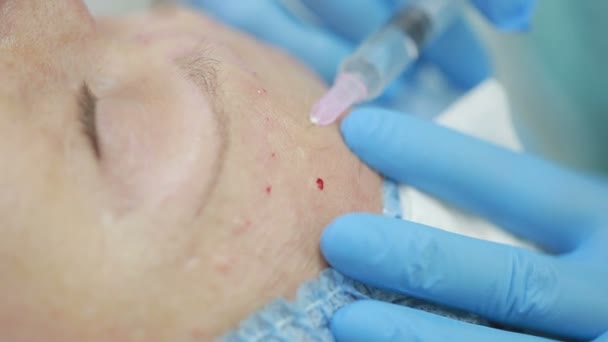 Tratamiento cosmético con inyección en una clínica. fortificación de la piel — Vídeo de stock