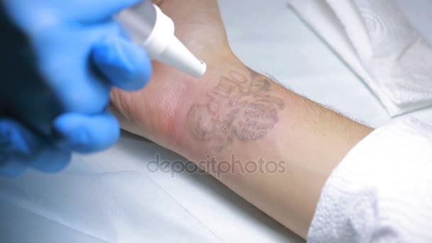 Laserové odstranění tetování s rukou — Stock video