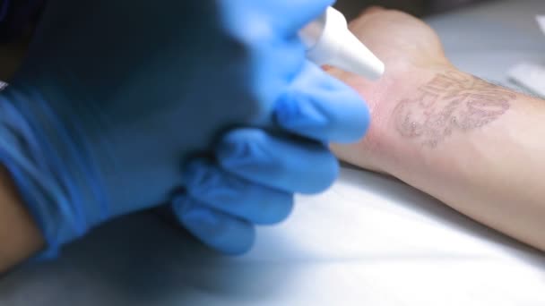 Laser-Tattooentfernung mit der Hand — Stockvideo