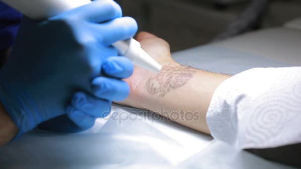 Laser-Tattooentfernung mit der Hand — Stockvideo