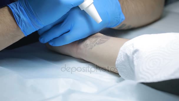 Laser tattoo verwijdering met hand — Stockvideo