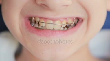 ayraçlar dişlerde çocuk gülümseyen