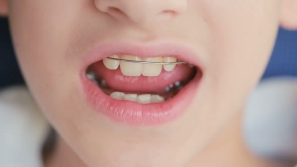 Niño sonriente con frenos en los dientes — Vídeos de Stock