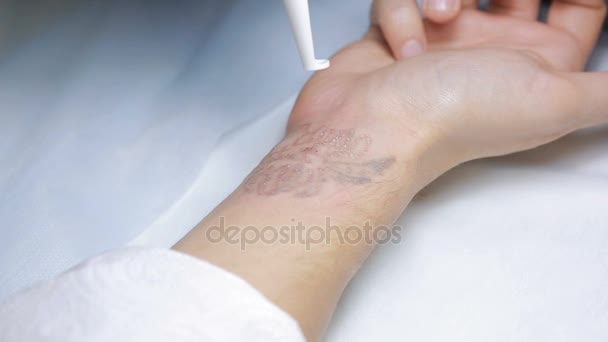 Лазерное удаление татуировки рукой — стоковое видео
