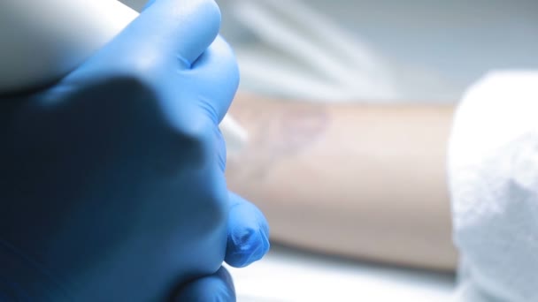 Laser tattoo verwijdering met hand — Stockvideo