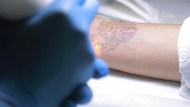 Eliminación de tatuajes láser con mano — Vídeos de Stock