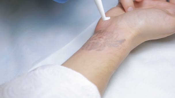 Eliminación de tatuajes láser con mano — Vídeo de stock