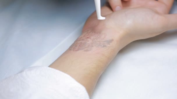 Rimozione del tatuaggio laser con mano — Video Stock